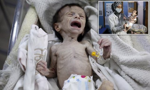 Malnourished Syrian baby is treated at a clinic in a rebel-held town