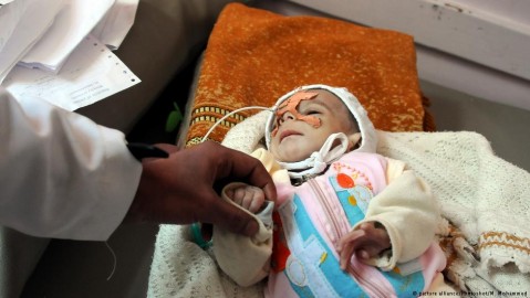A malnourished child in Yemen. Photo: Photoshot/M. Mohammed